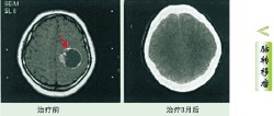 Metastase otak