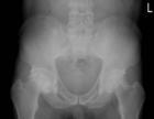 Aseptic necrosis dari kepala femoral