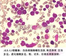 Leukemia lymphoblastic akut