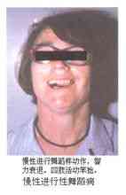 Chorea Huntington