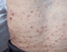 Neurofibromatosis