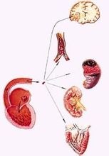 Emboli arteri perifer