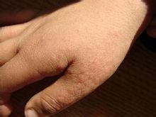 Infantil acrodermatitis papular