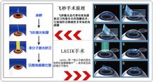Operasi laser mata Femtosecond