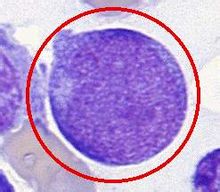 Leukemia promyelocytic akut