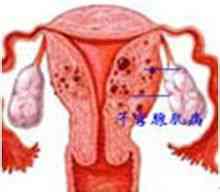 Adenomiosis
