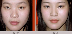 Embedding Eyelid