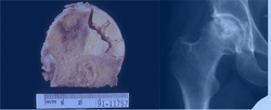 Osteonekrosis