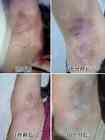 Bekas luka contracture
